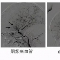 “河南经验”写入最新烟雾病中国专家共识